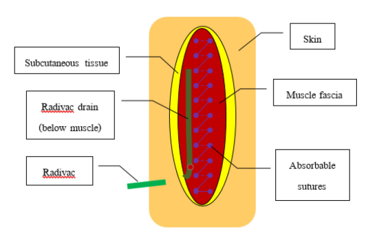 Instilled anesthetic cocktails or NSS 20 mL between the muscle fascia and subcutaneous layer