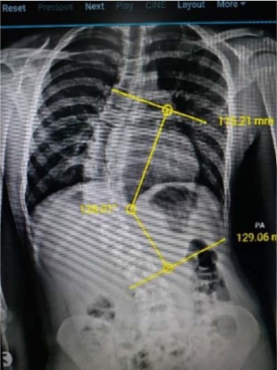 Cobb angle performed at Hospital E using digital measurement