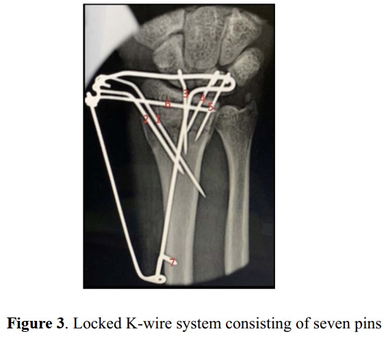 Locked K-wire system consisting of seven pins