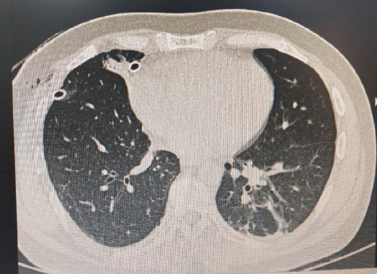 HRCT chest on the day of admission