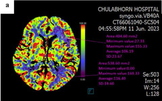 A cerebral blood flow map showing variations in blood flow across regions of 404.60 mm² and 538.60 mm²