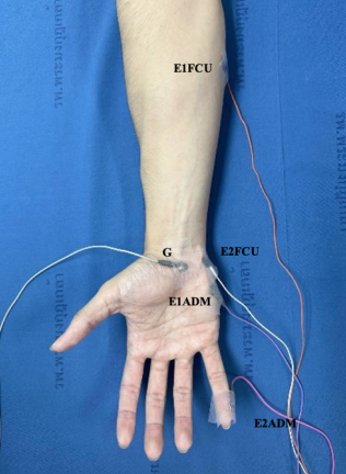 Electrode placement for ulnar motor nerve conduction study recorded from the flexor carpi ulnaris (FCU) muscle